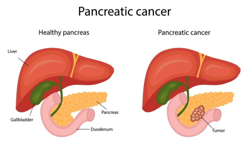 Pancreatic Cancer Treatment in India